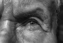 Glaucoma pseudoesfoliativo